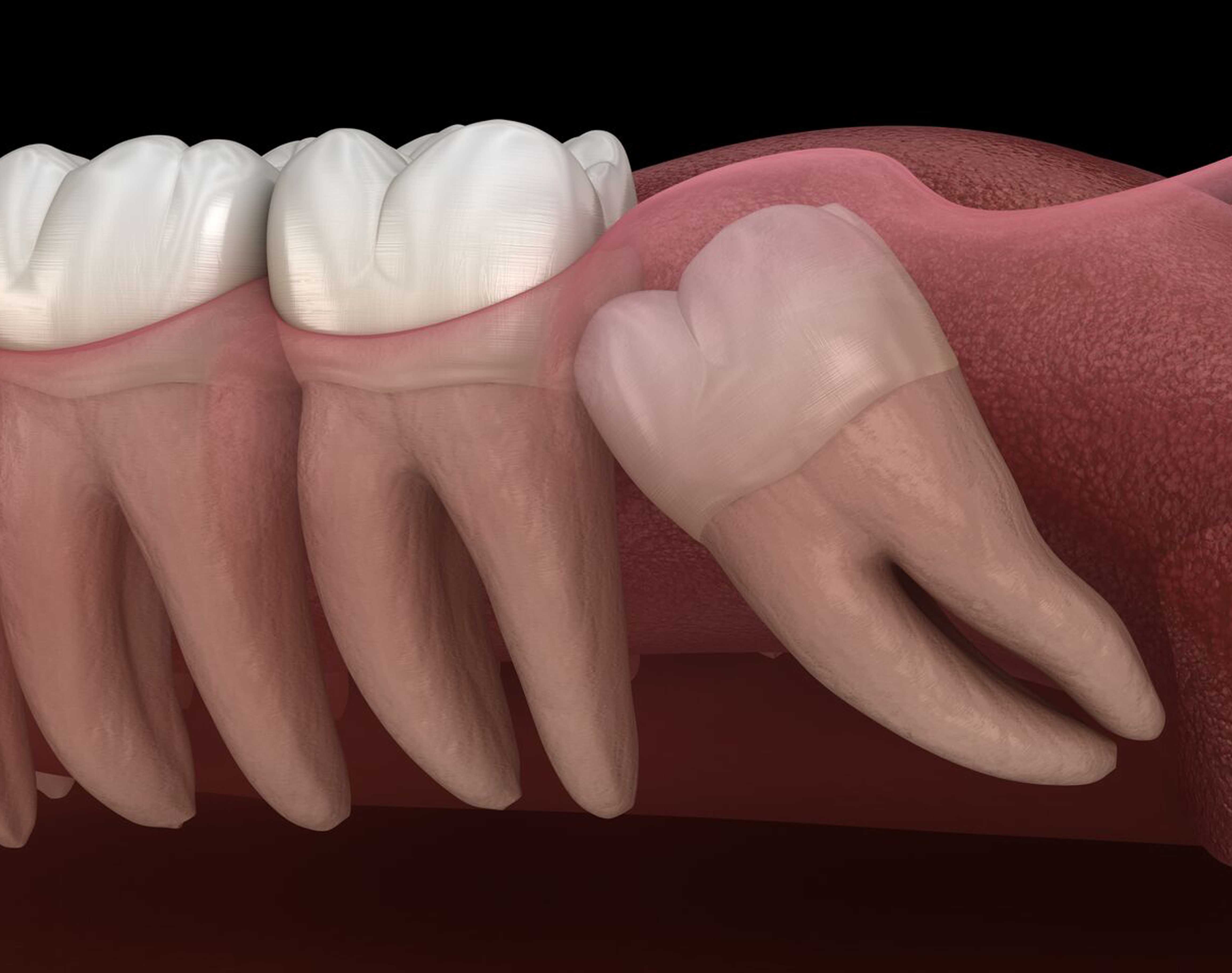 Полуретинированного зуба