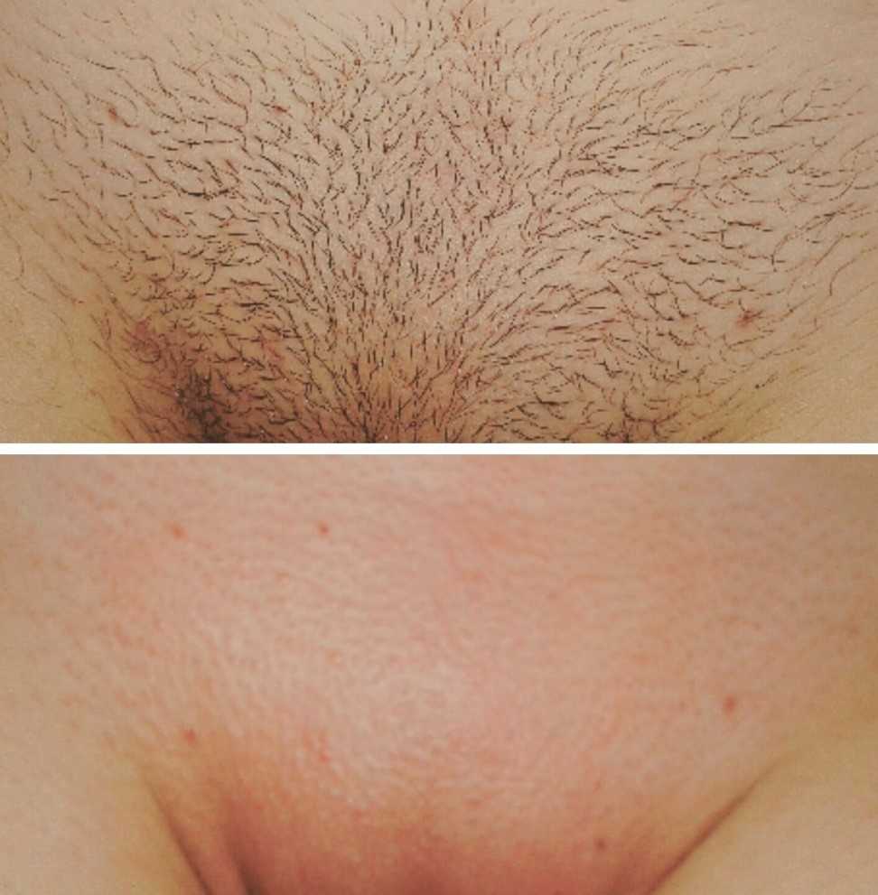 волосы на грудях у женщин удаление фото 35
