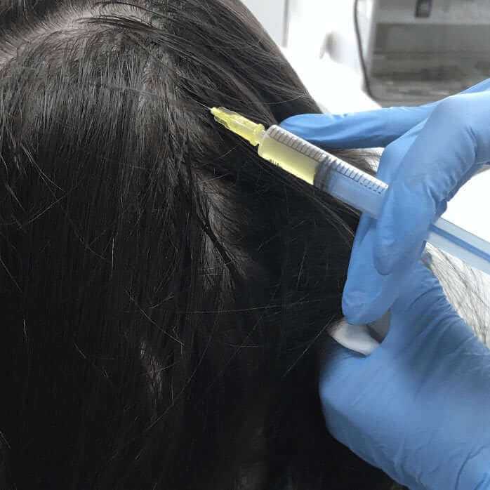 Насколько эффективна пересадка волос?