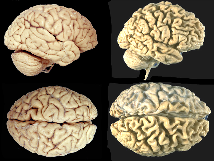 В.а.яковлев "когнитивные расстройства в зрелом и пожилом возрасте" функциональная анатомия старения мозга. когнитивные нарушения при нормальном старении.