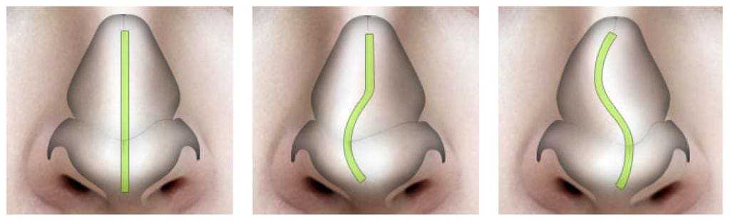Операция по исправлению носовой перегородки: показания и опасность | food and health