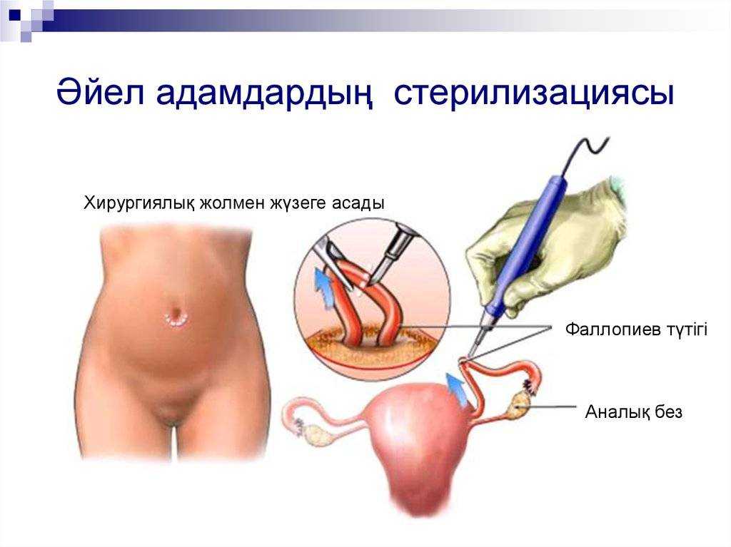 Спайки маточных труб: лапароскопия, операция - women first