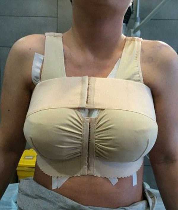 Риски и осложнения при увеличении груди | александр маркушин пластический хирург