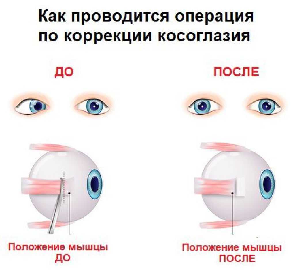Лечение после операции глаз