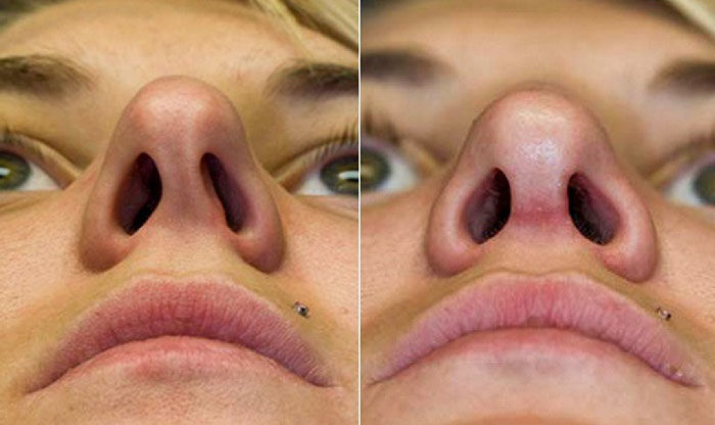 Разные ноздри - как исправить пластической хирургией | проблемы и решения