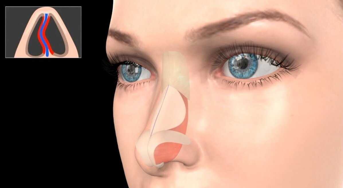 Искривление перегородки носа - современные методы лечения