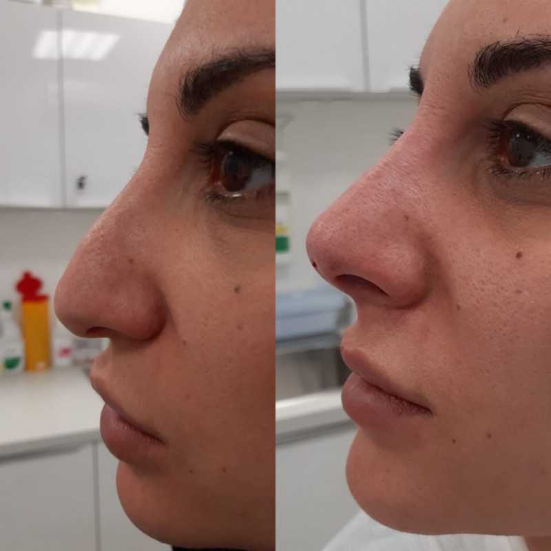 Безоперационная пластика носа: как это происходит | статьи и советы | блог клиники пластической хирургии «основа»