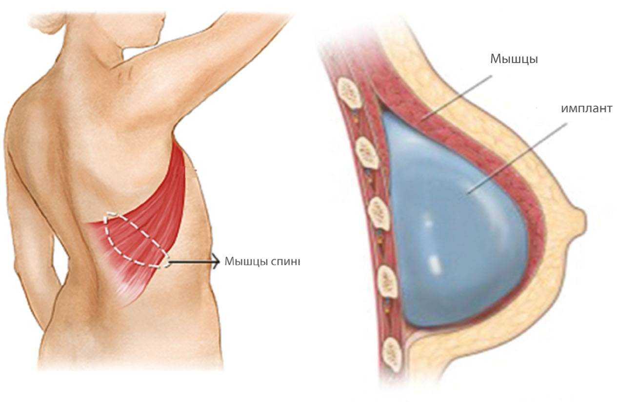 удаление и восстановление груди в одну операцию фото 65