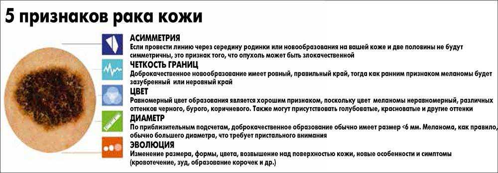 Какие «родинки» опасны?