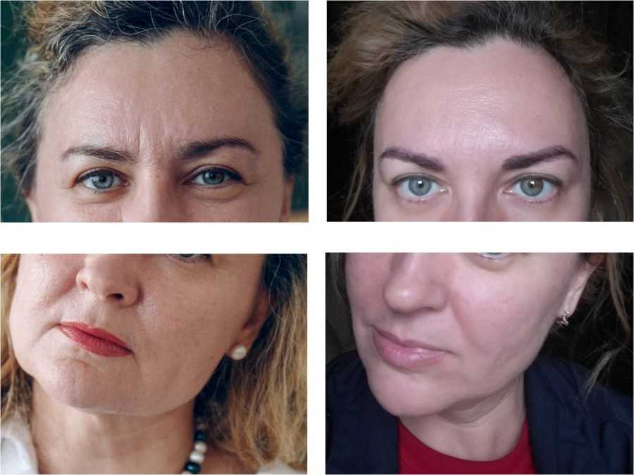 Эффект  "надутого лица": почему после введения филлеров возникает деформация внешности