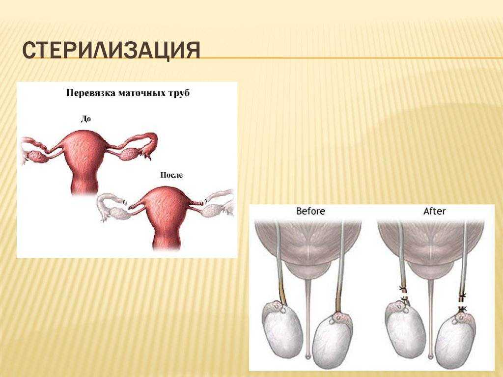 Перевязка маточных труб картинки