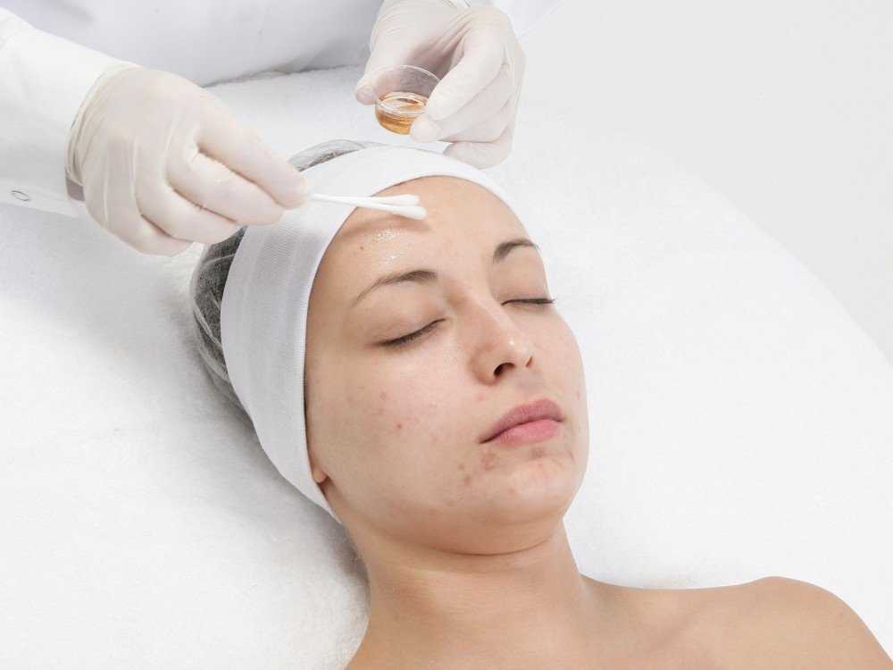 Уход за кожей после пилинга лица. советы, рекомендации, особенности