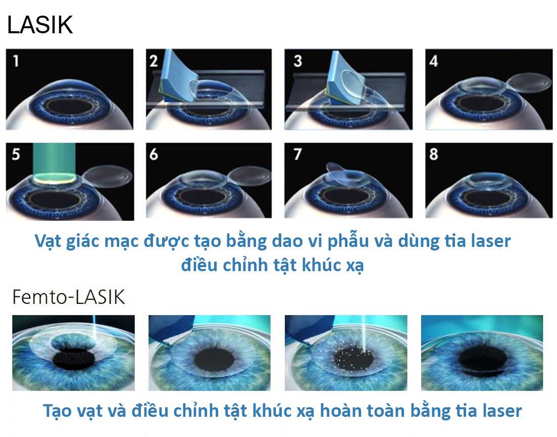Коррекция зрения сравнение. Фемто ласик лазерная коррекция. Фемто ласик этапы. Лазерная рефракционная кератопластика (методом Femto super LASIK).