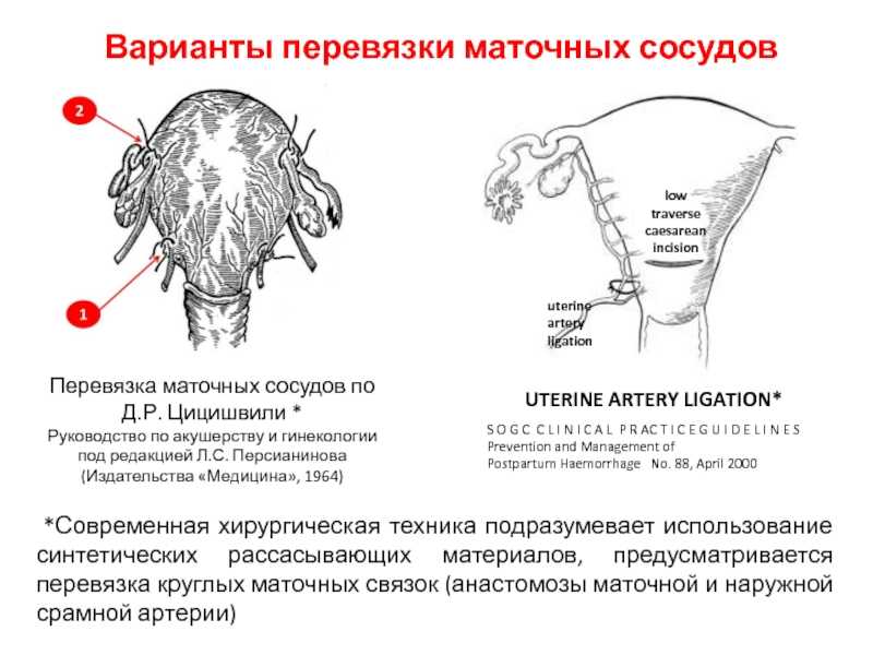 Хирургическая лапароскопическая/трансвагинальная стерилизация
