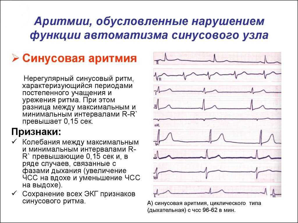 Если сердце сбилось с ритма: что делать и как сохранить жизнь, объясняет кардиолог.