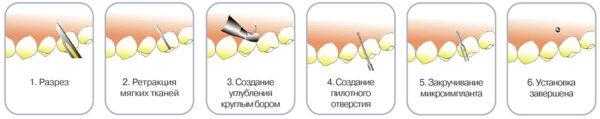 Индекс десна. Мини имплант ортодонтический винт. Минивинты ортодонтические схема. Минивинты микроимпланты. Ортодонт микроимпланты.