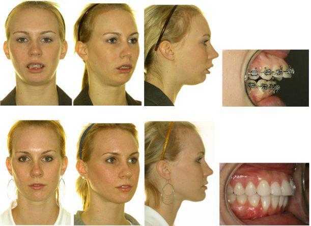 Хейлопластика: виды хирургического увеличения губ