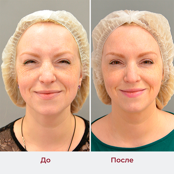 Ботулинотерапия в косметологии до и после. Ботулинотерапия лица до после. Ботулинотерапия овал лица. Ботулинотерапия от морщин skinlift ru