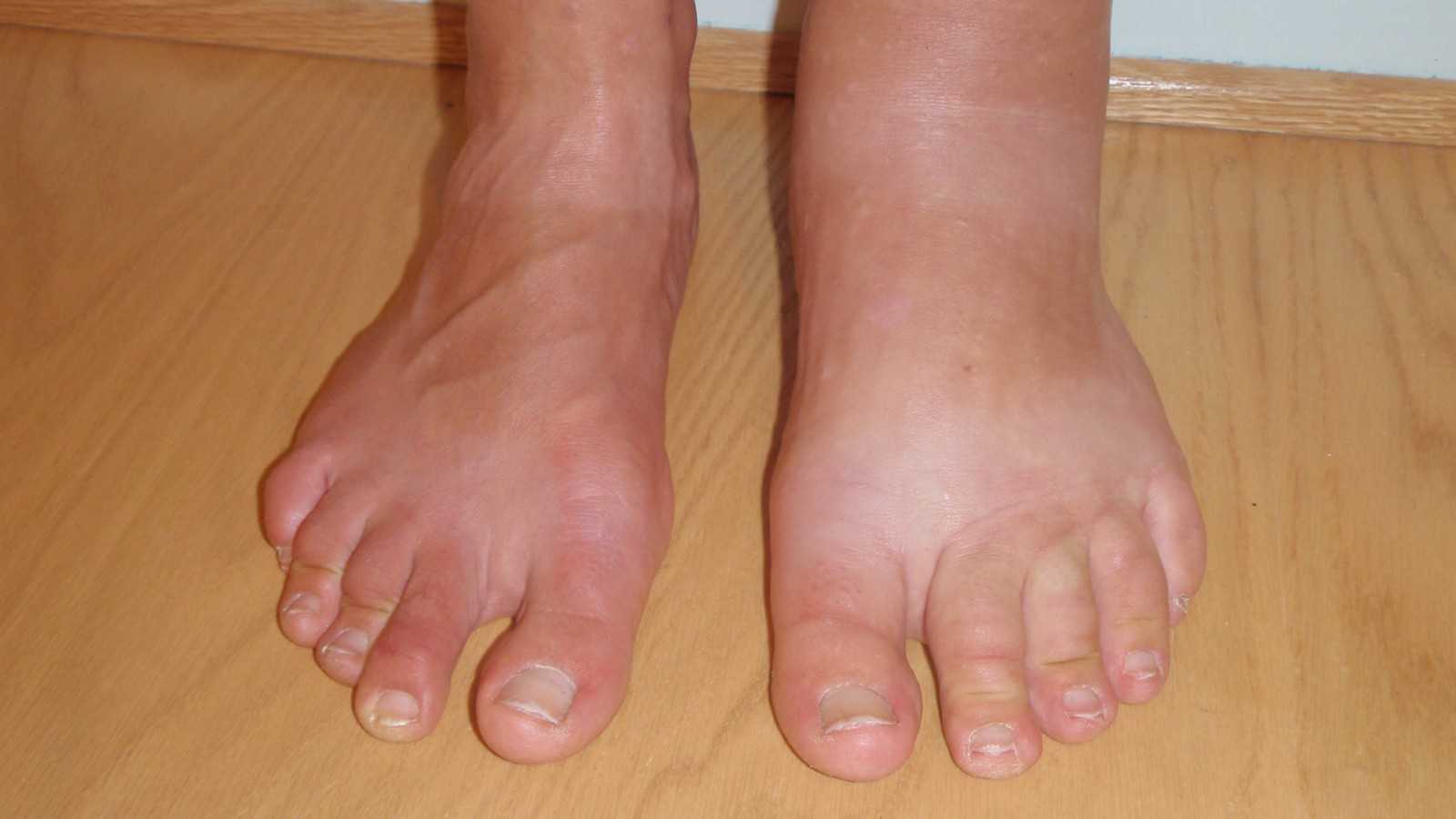 Атеросклероз нижних конечностей – облитерирующий и хронический - причина онемения ног.