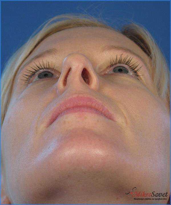 Септопластика: исправление искривления носовой перегородки