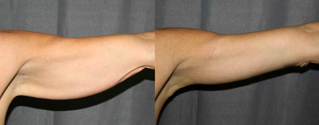 На фото: руки до и после операции  — институт пластической хирургии на трубной