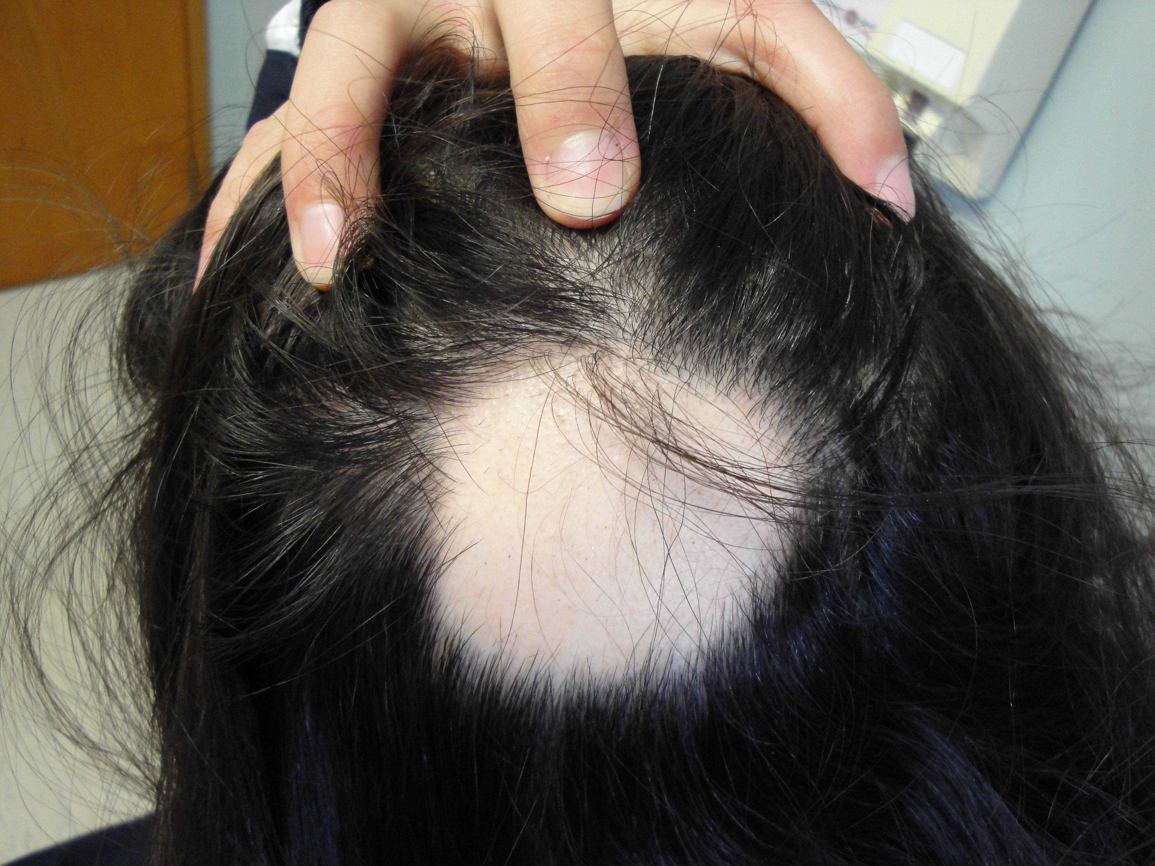 Народные лечение выпадения волос очагов