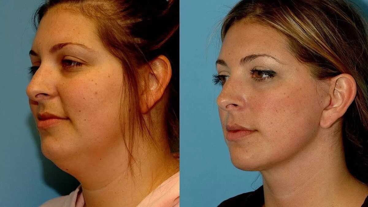 Липолитики для похудения - что это такое: инъекции липолитиков в живот, лицо, отзывы, фото до и после