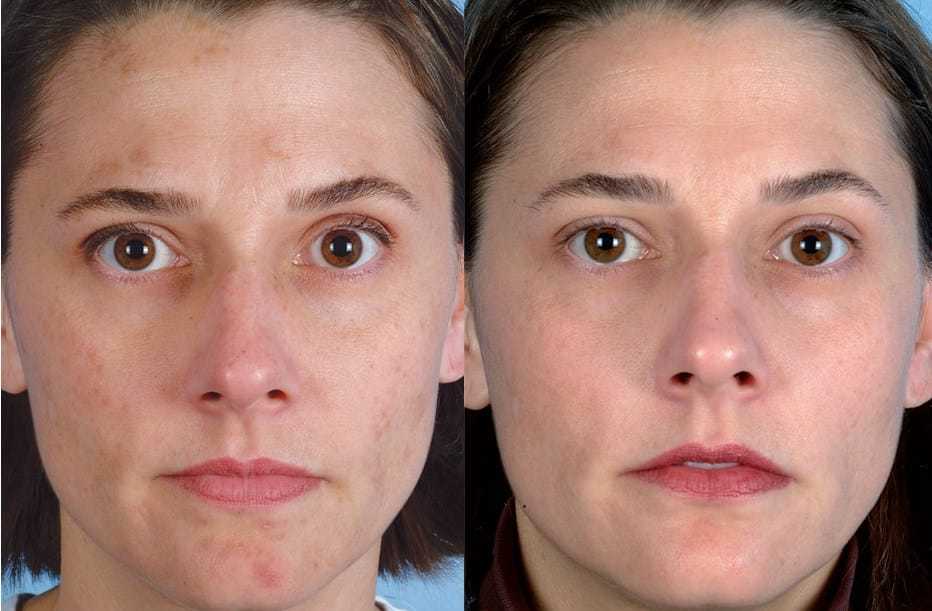 Мелкоморщинистый тип старения кожи лица: как бороться и что делать, фото, признаки морщинистого морфотипа, процедуры для ухода