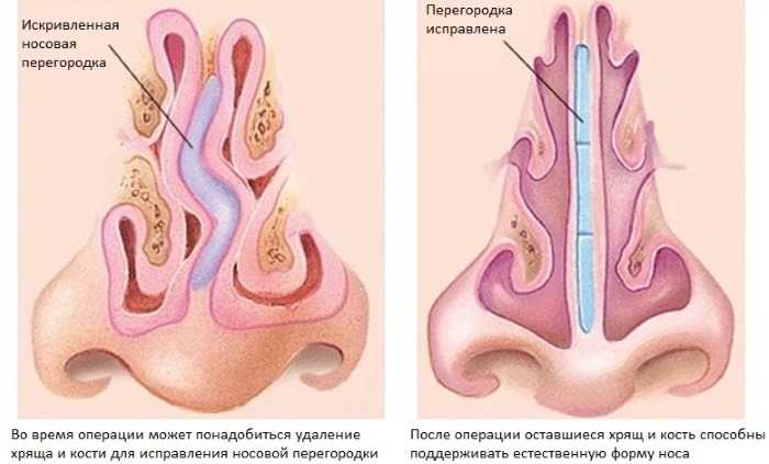 Искривление носовой перегородки у детей - симптомы болезни, профилактика и лечение искривления носовой перегородки у детей, причины заболевания и его диагностика на eurolab