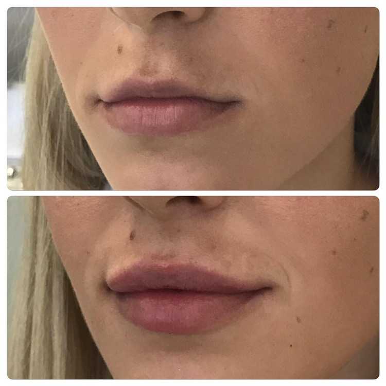 Узкие губы после увеличения фото