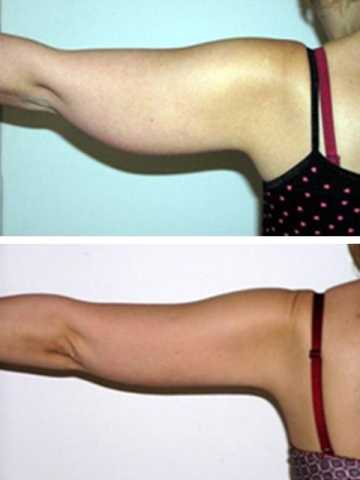 Брахиопластика рук: фото до и после