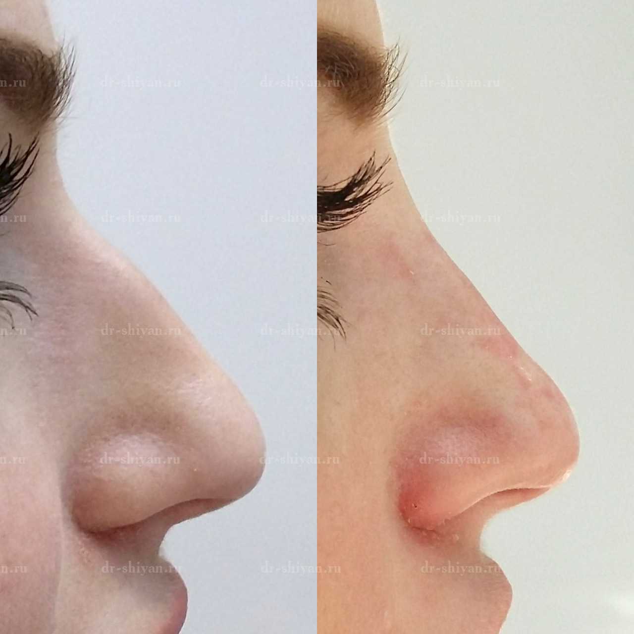 Инъекционная ринопластика носа – фото и отзывы
