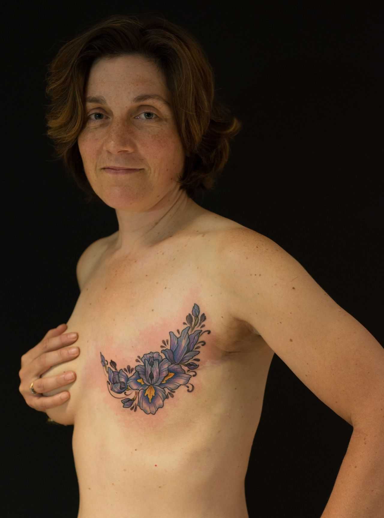 удаление и восстановление груди в одну операцию фото 47