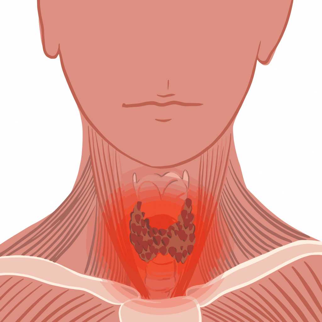Щитовидка какие болезни. Острый тиреоидит щитовидной железы. Хронический тиреоидит ЩЖ. Тиреоидит воспаление щитовидной. Подострый тиреоидит щитовидной железы.