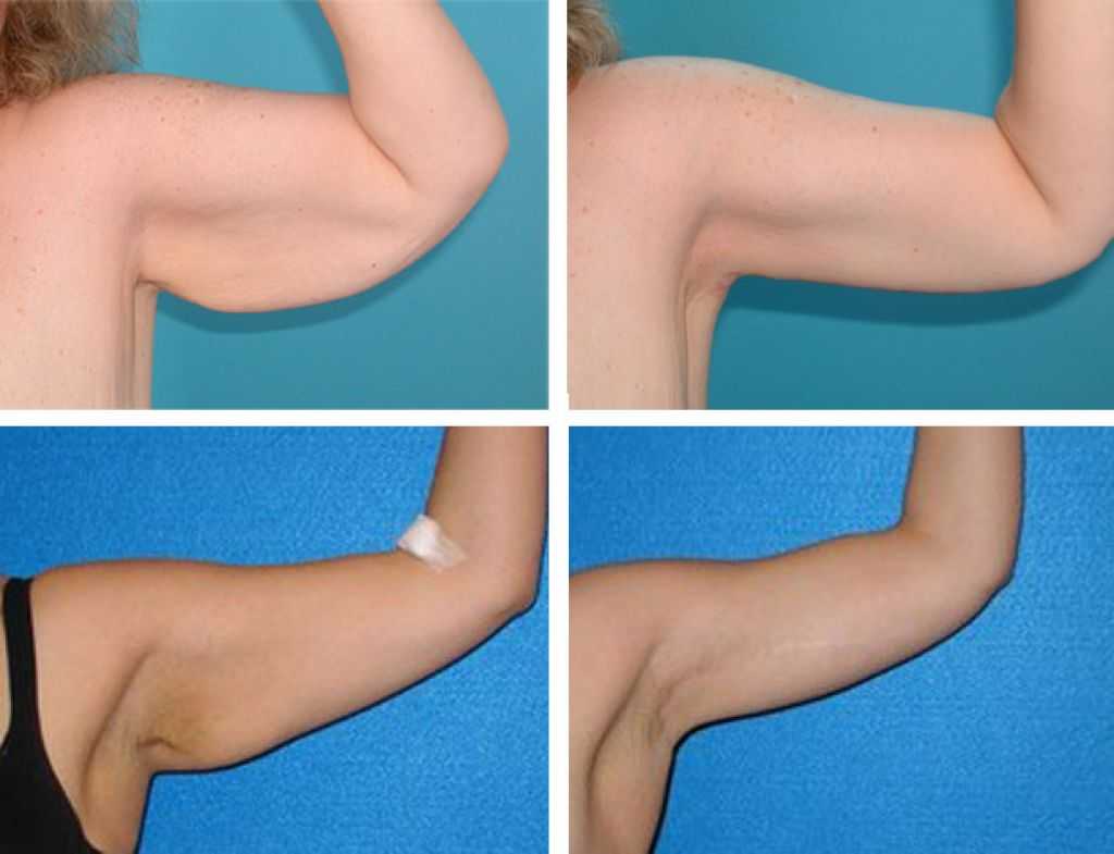 Брахиопластика (подтяжка кожи рук) — фото до и после операции | цэлт!