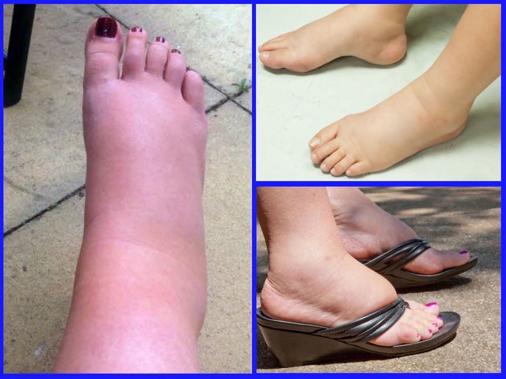 Онемение ног — что может вызвать  этот симптом? - цэлт