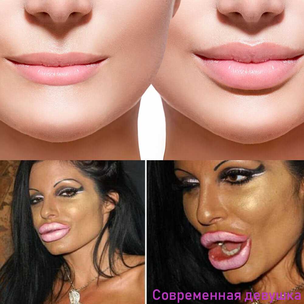 Фото губ накаченных до и после у девушек