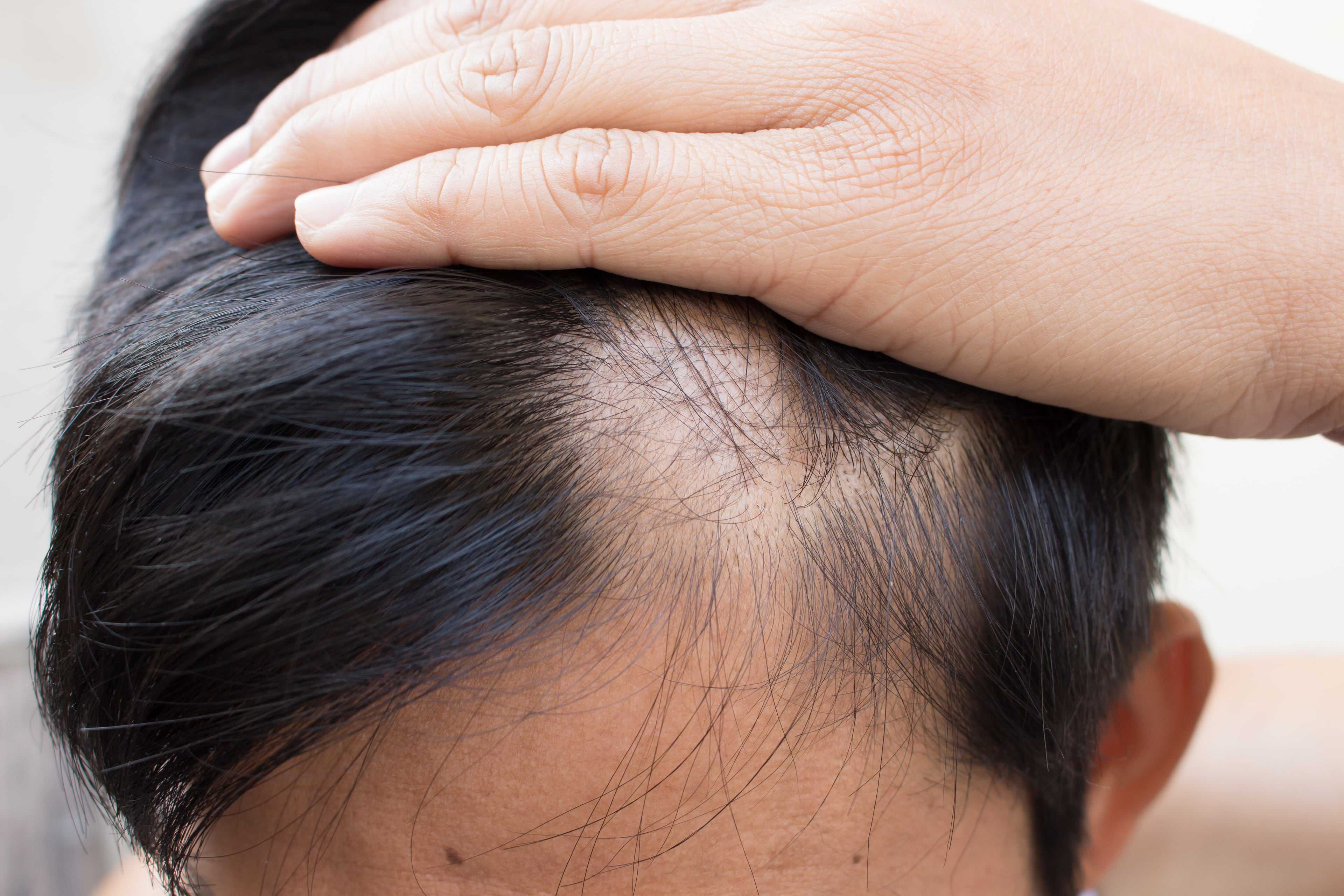 Жирная кожа головы и выпадение волос у мужчин как лечить