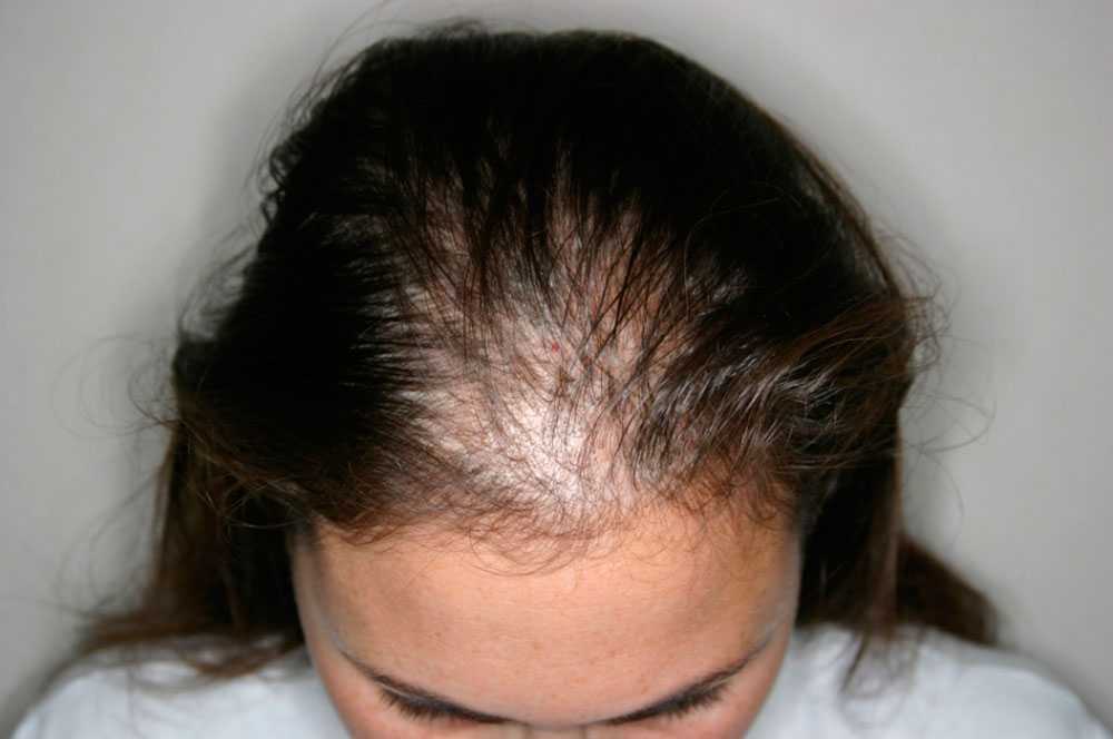 Плазмотерапия волос: плюсы и минусы | блог expert clinics