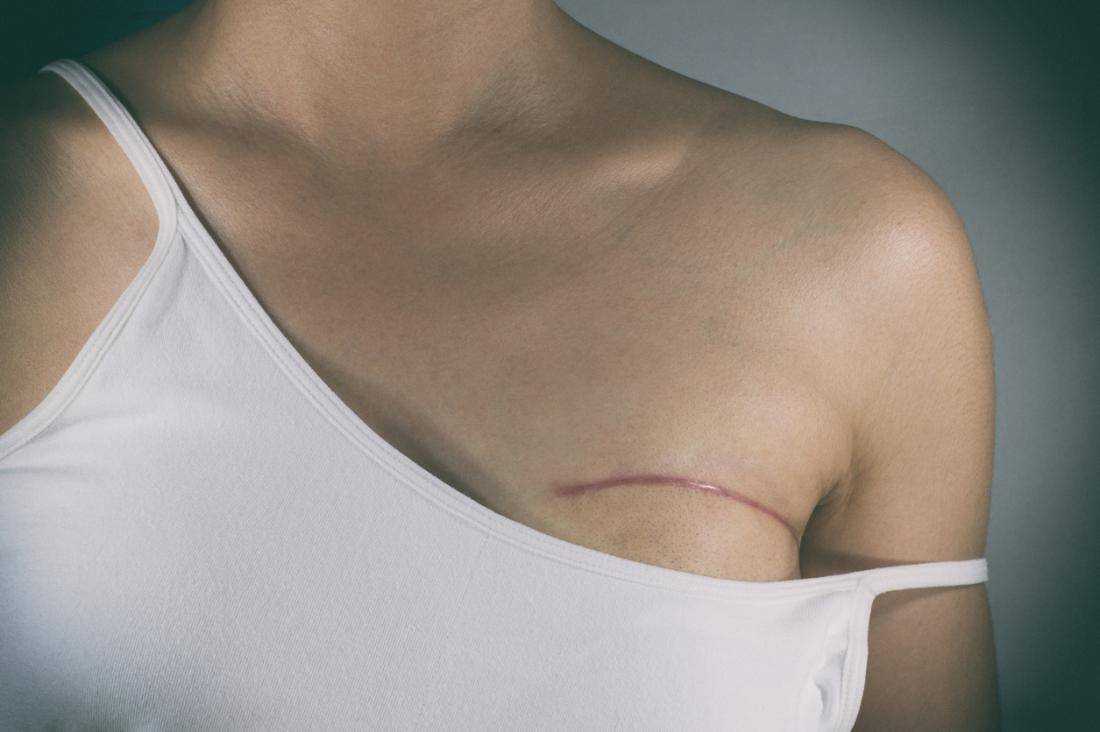 что такое кальцинаты в женской груди фото 108